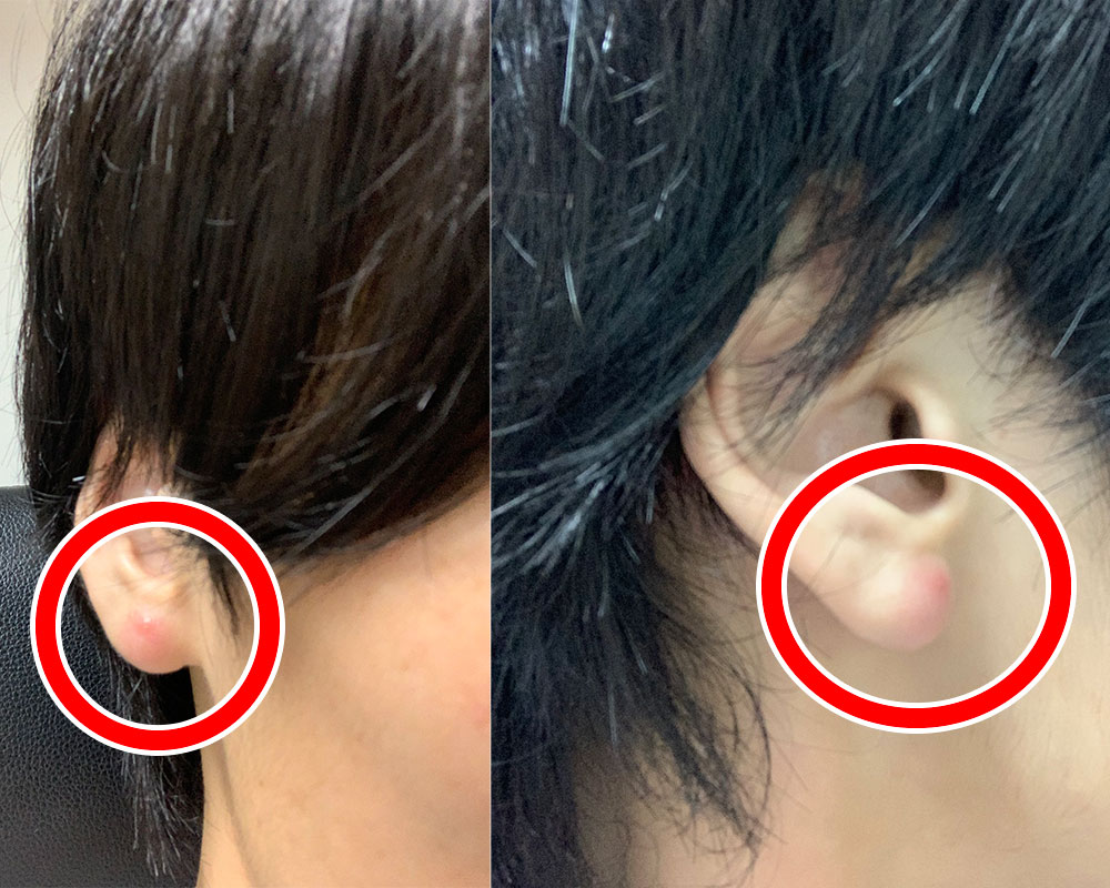 耳のしこり（粉瘤）の画像